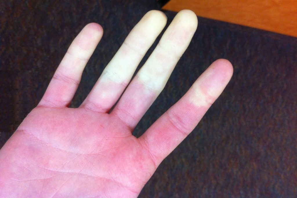 Enfermedad de Raynaud