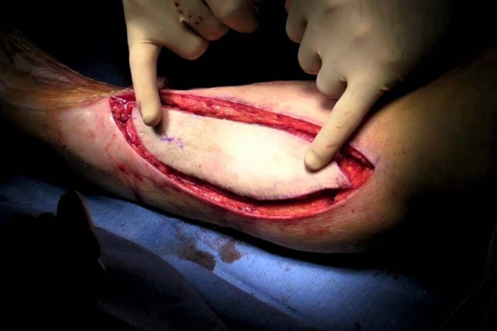Injertos y colgados musculocutáneos complicados