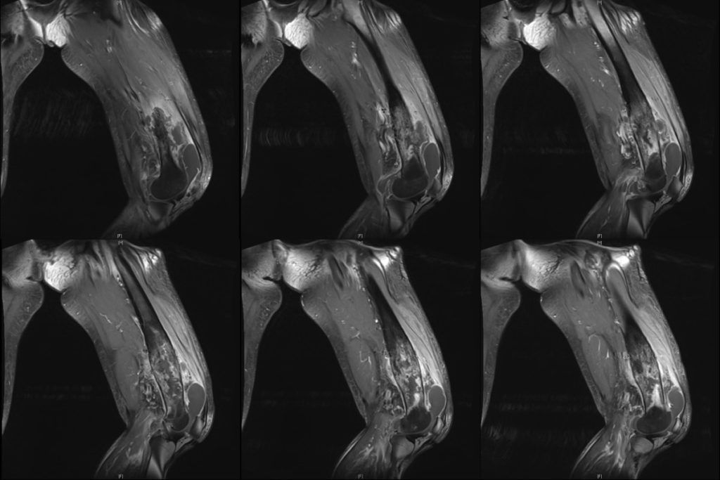 Osteomielitis refractaria del fémur