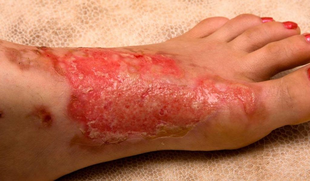 Oxigenoterapia Hiperbárica en el tratamiento de las Quemaduras Térmicas