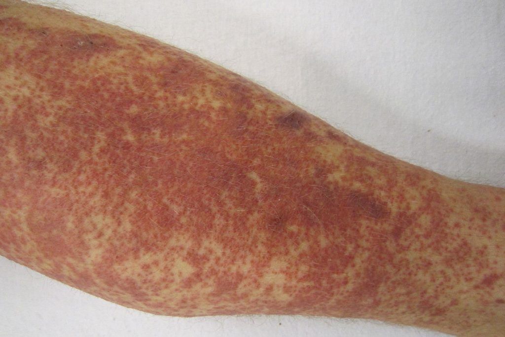 Vasculitis refractaria en pierna