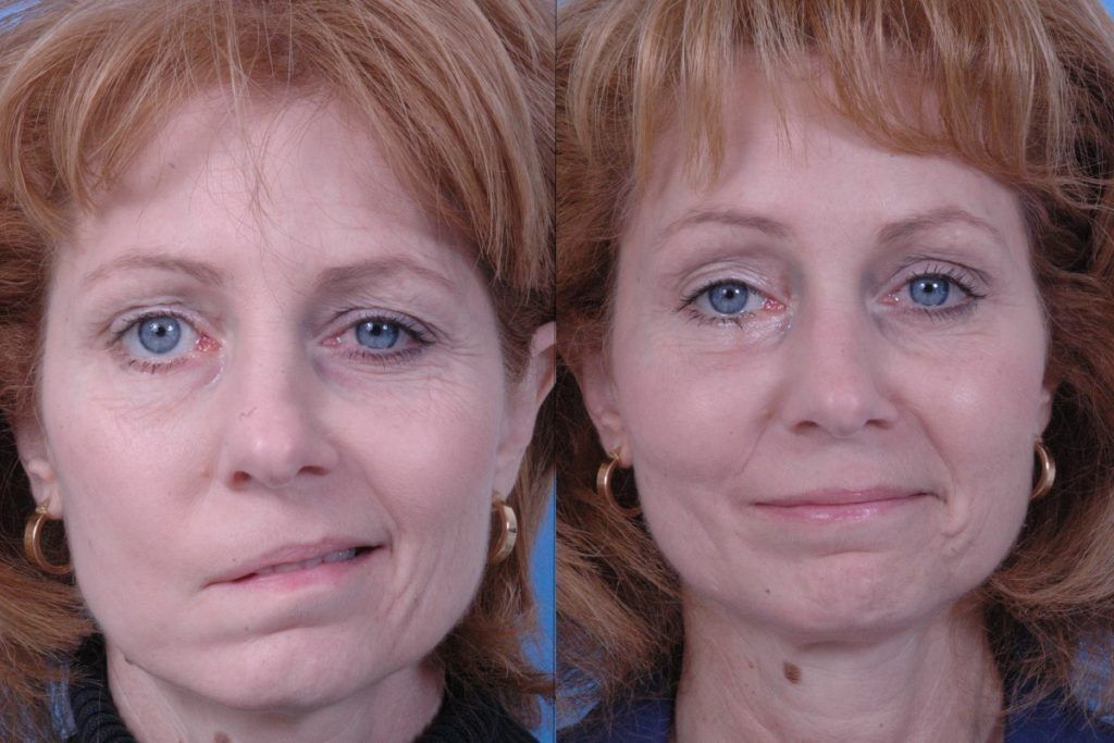 Parálisis Facial (de Bell)