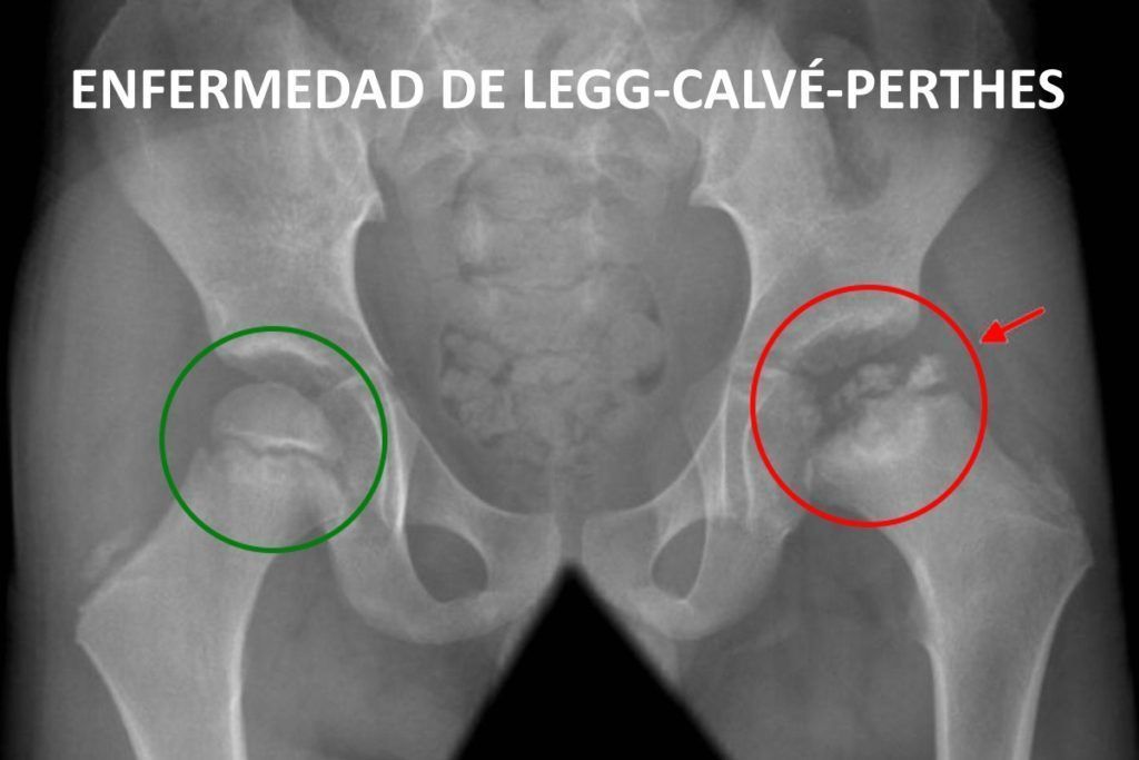 Radiografía Enfermedad de Legg-Calvé-Perthes