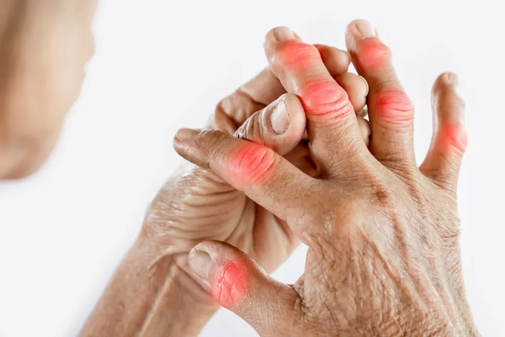 La Artritis Reumatoide mejora con la Oxigenoterapia hiperbárica 1 Artritis Reumatoide