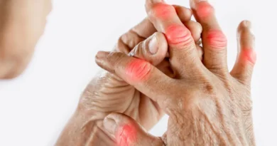 Artritis Reumatoide
