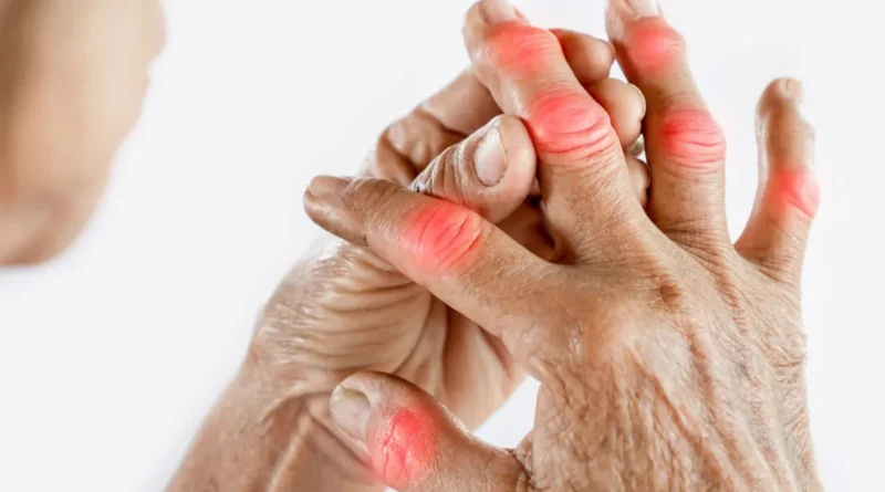Artritis Reumatoide